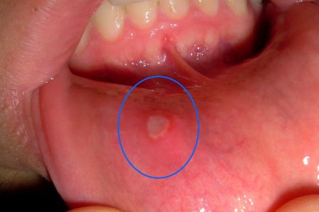 آفت دهان چیست؟ درمان ، پیشگیری و علائم